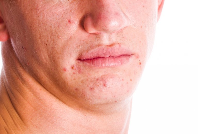 Aliviar y prevenir el acné